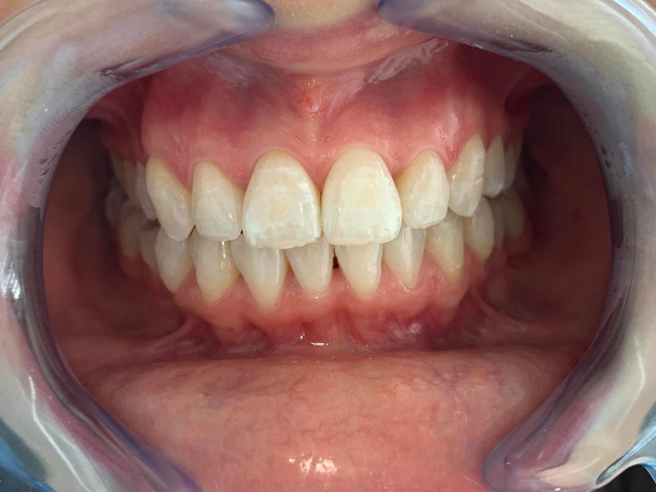 Alinhadores Dentários na Clínica Pedral