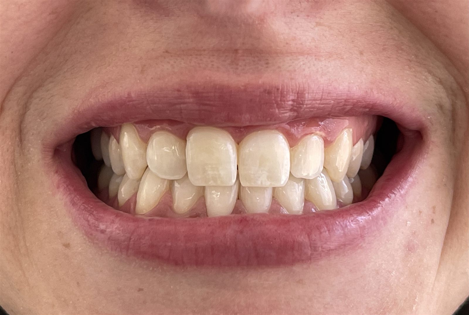 Branqueamento Dentário na Clínica Pedral